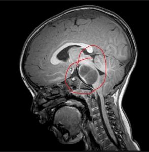 MRI Scan of Brain with DIPG